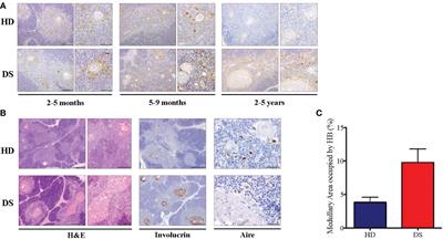 Premature Senescence and Increased Oxidative Stress in the Thymus of Down Syndrome Patients